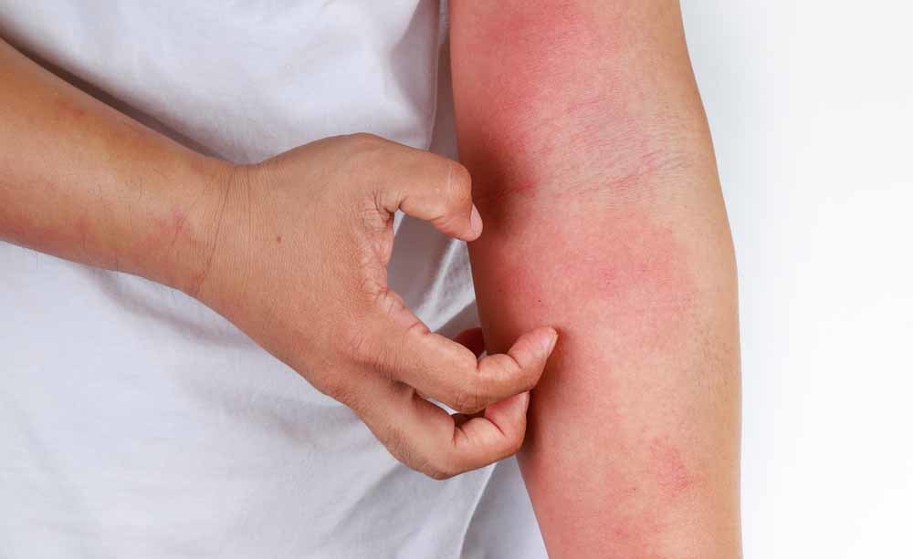 dermatite e allergia