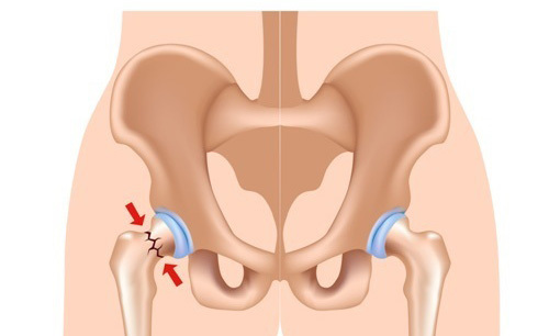 Frattura femore: ecco come evitarla