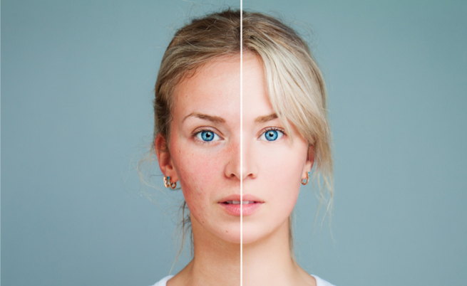 caffeina e rosacea: per alleviare i sintomi