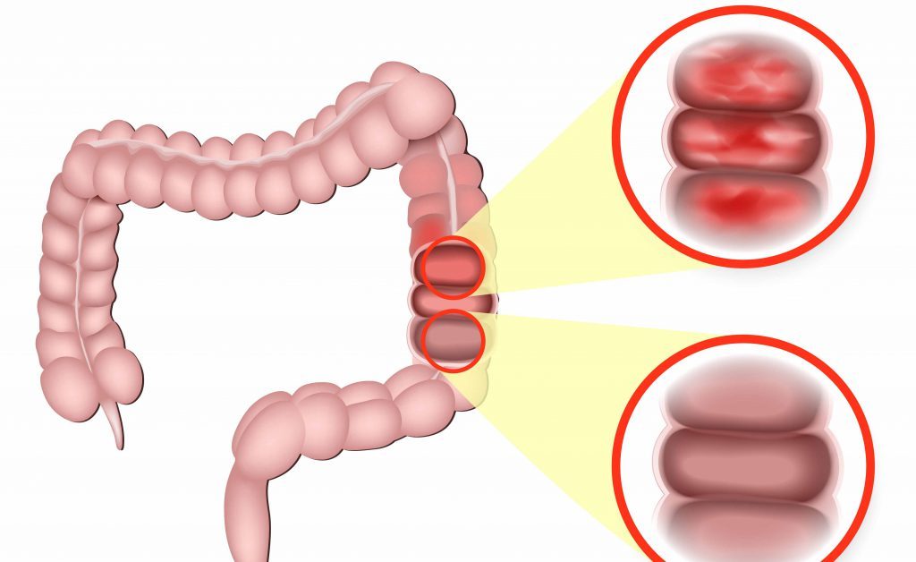 MICI e farmaci biosimilari