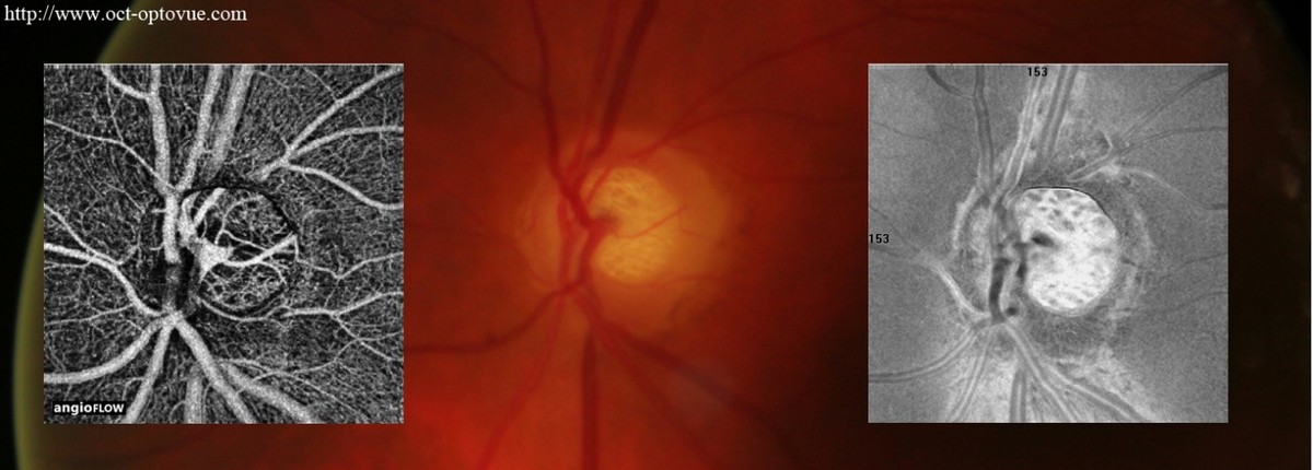 esame occhio: glaucoma