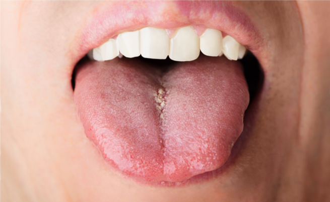 psoriasi lingua e bocca: sintomi e cause