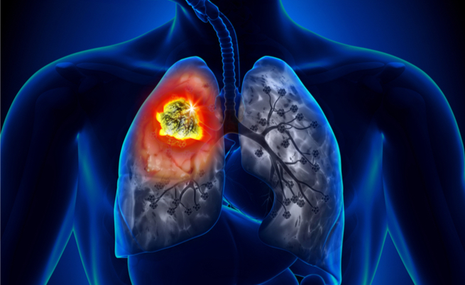 tac spirale tumore ai polmoni: per la diagnosi precoce