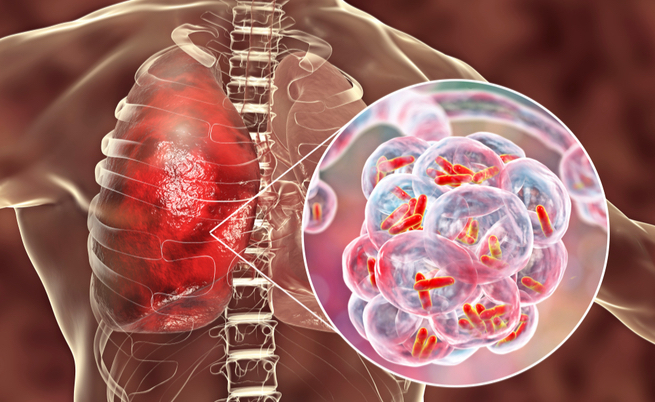 polmonite batterica: pericolosa per il cuore