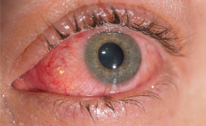 lacrimazione causata dal freddo: cosa fare? I rimedi