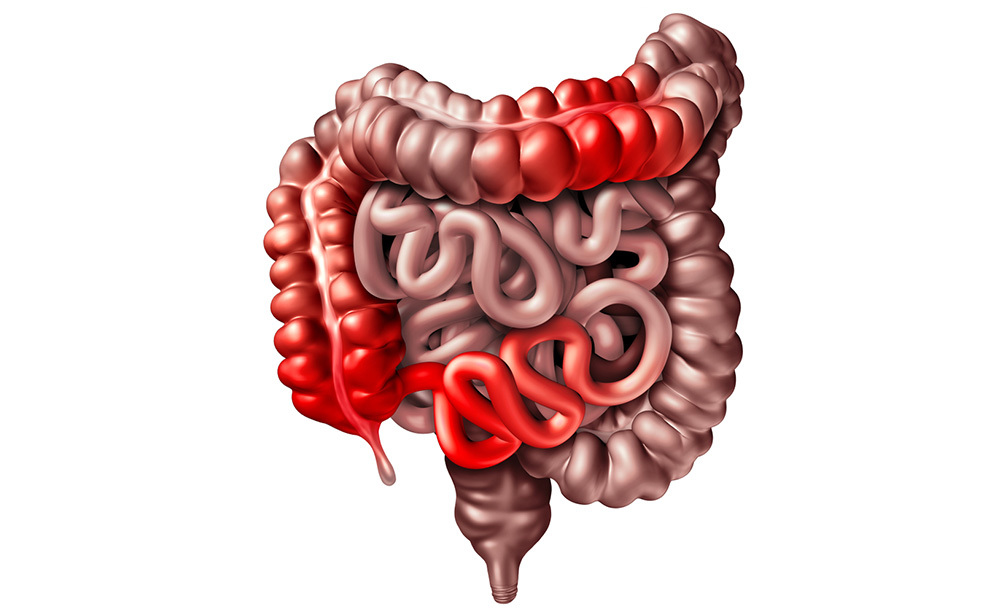 Crohn e Complicazioni con il passare degli anni