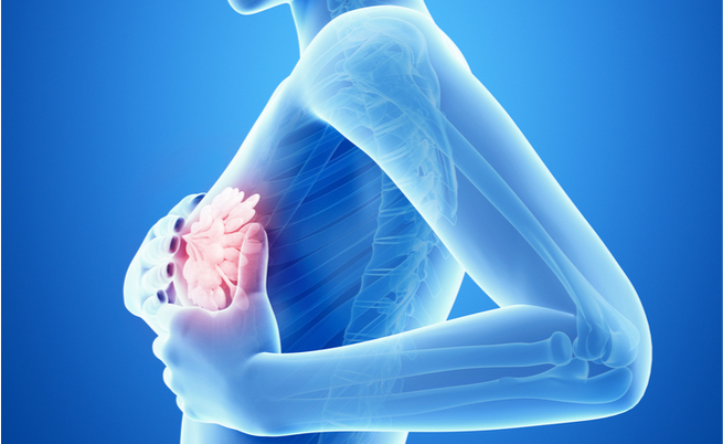 carni processate e cancro al seno: il legame