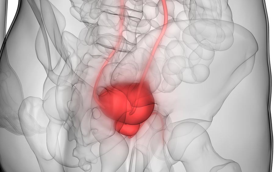 Tumore alla vescica: le Cure