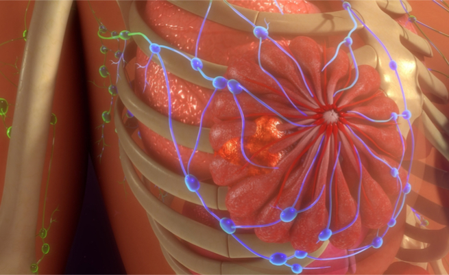sopravvivenza tumore metastasi: qual è l'aspettativa di vita?