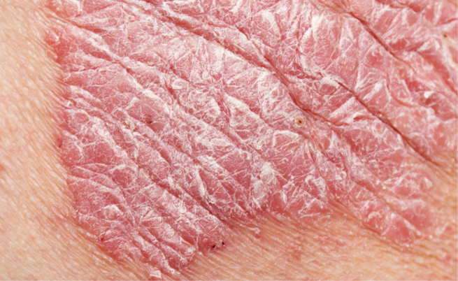 fattori scatenanti psoriasi: quali sono