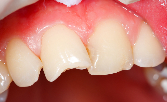 Come curare un ascesso dentale con rimedi naturali