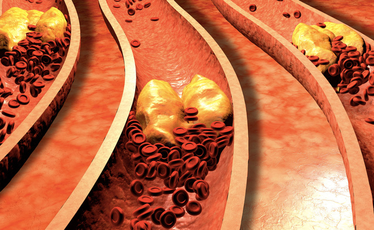 Colesterolo alto: i Rimedi Naturali