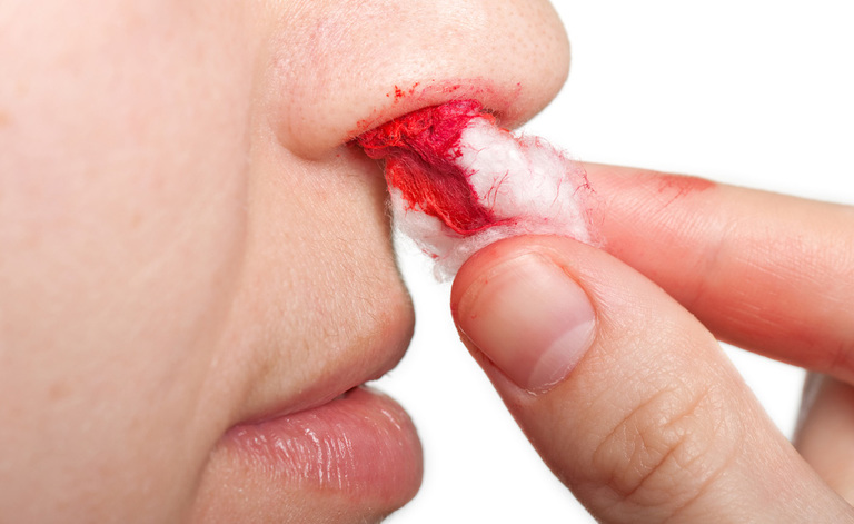 Sangue dal naso: cosa fare