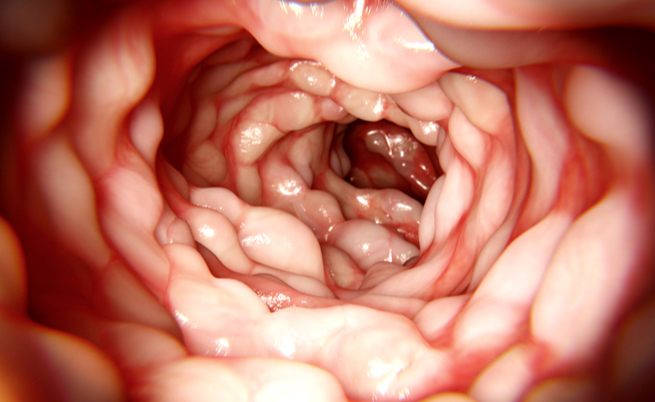 Rischio morbo di crohn? Ecco cosa c'entrano le mutazioni genetiche