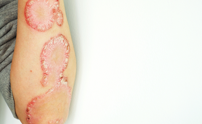 Brodalumab psoriasi: il farmaco che elimina le lesioni