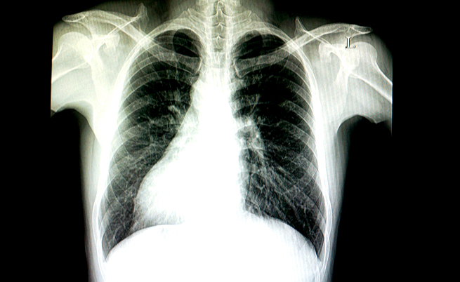 situs inversus: cos'è