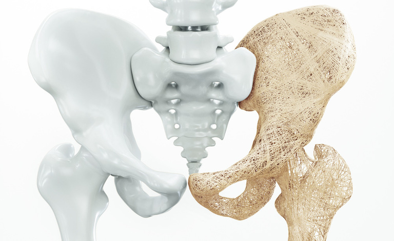 osteoporosi e celiachia: ecco il legame
