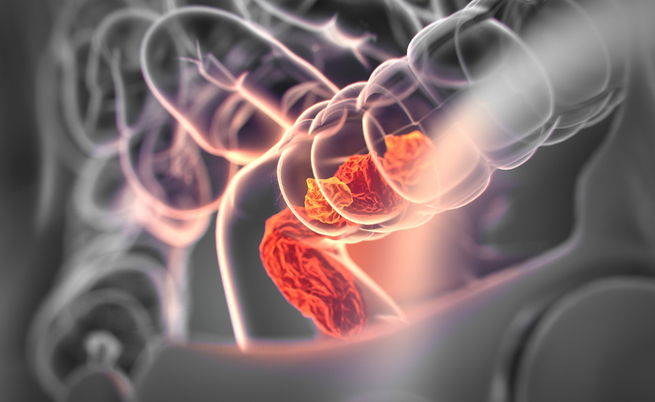 prevenzione cancro: come ridurre il rischio?