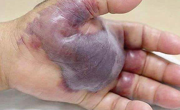 mangia sushi e gli amputano il braccio: succede in Sud Corea