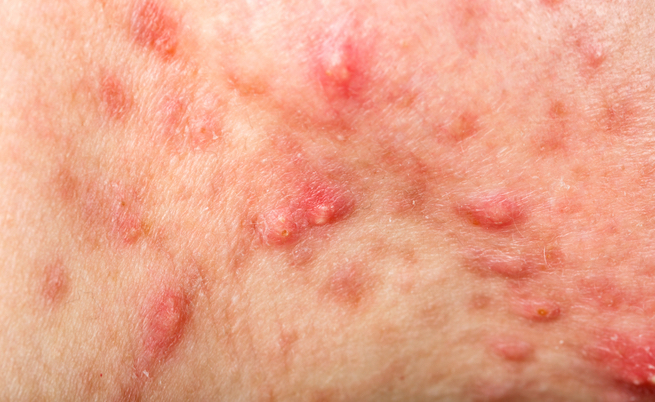 Rimedi naturali per la follicolite da depilazione