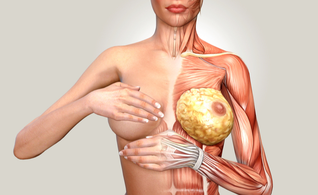 Seno fibrocistico: il rischio di Tumore è alto?