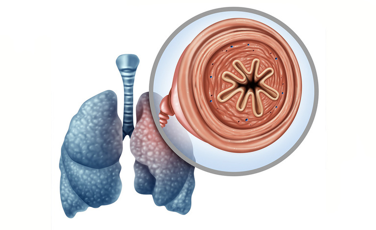 Enfisema: i Sintomi e le Cure