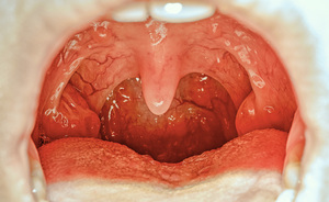 Le 10 cause più comuni di ulcera allo stomaco | Pazienti.it