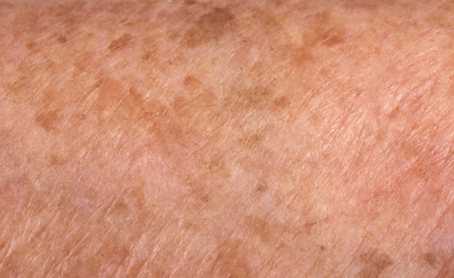 I rimedi della nonna per le macchie scure sulla pelle