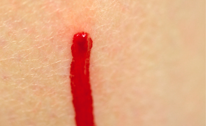 perché le ferite non si cicatrizzano: tutti i motivi