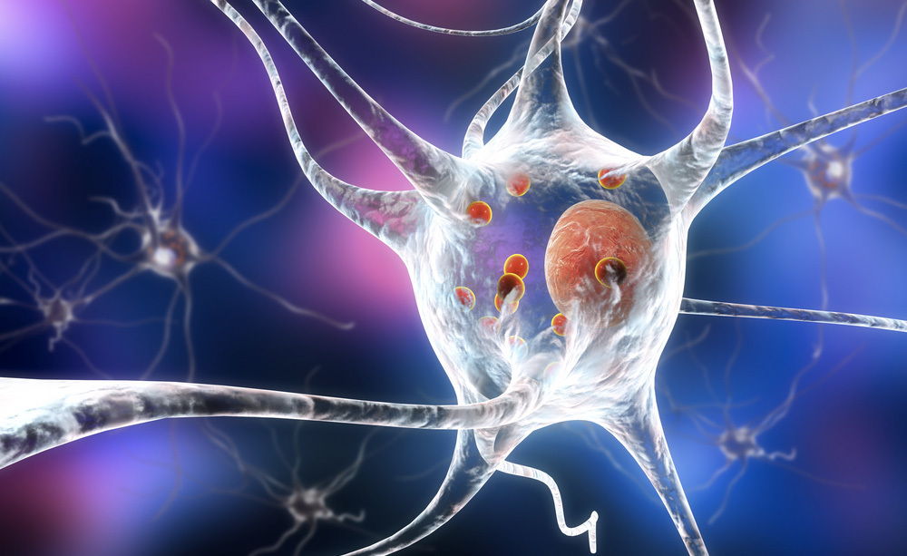 Parkinson e Difficoltà di Parola: ecco cosa Fare