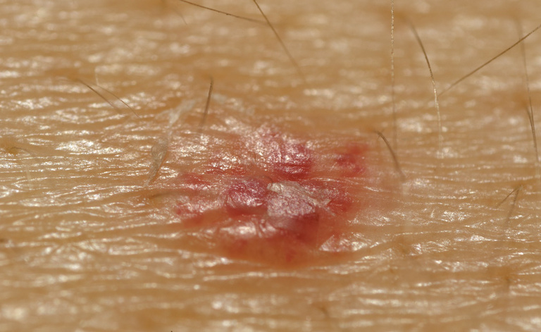 Melanoma: i Sintomi e le Cure