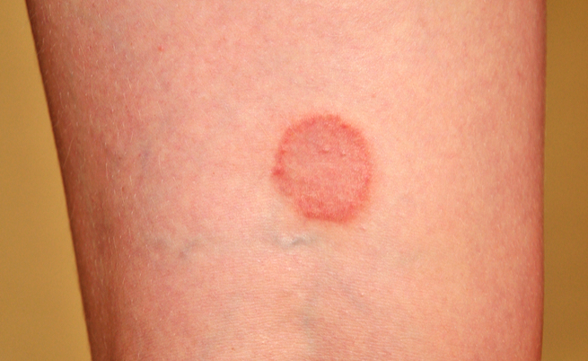 lichen planus: sintomi e cure