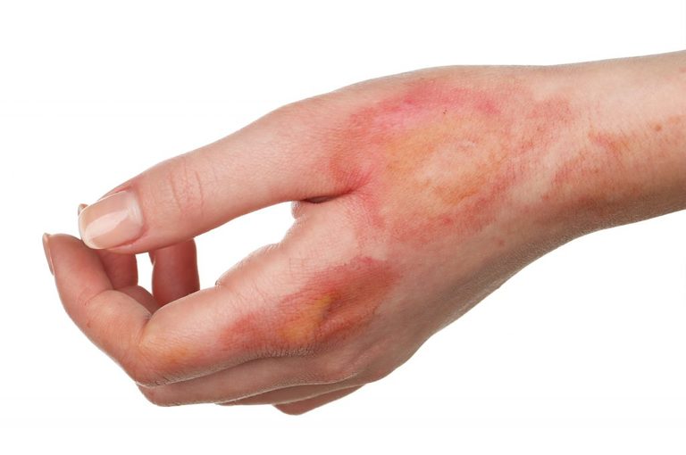 Rimedi (naturali) per le ustioni