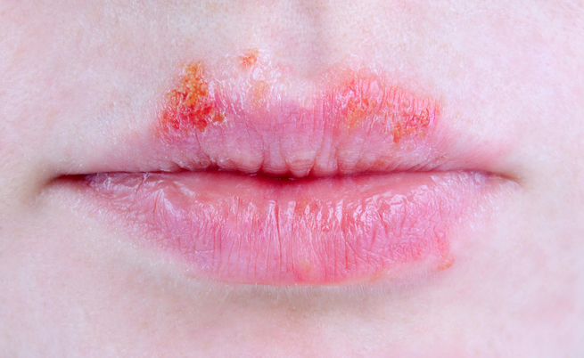 vaccino herpes simplex: i risultati