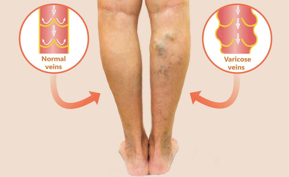 Vene: perché le Fragole fanno Bene