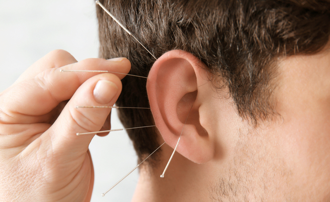 Come funziona l'agopuntura per dimagrire