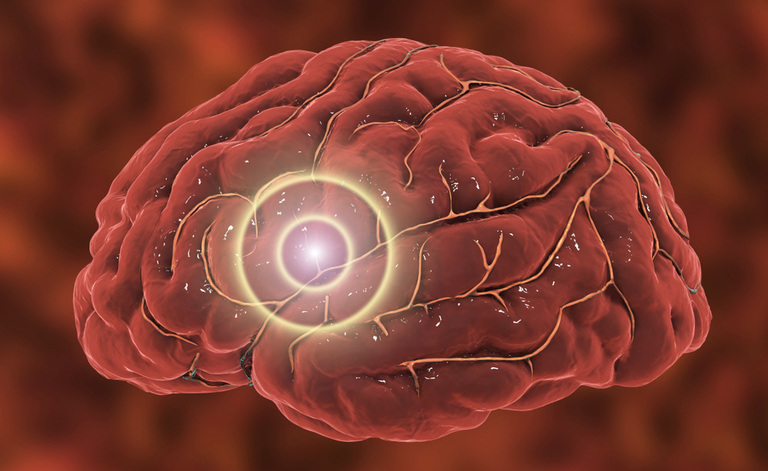 Ictus e Afasia: ecco cosa fare