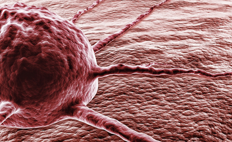 Tumore al colon e Biopsia Liquida