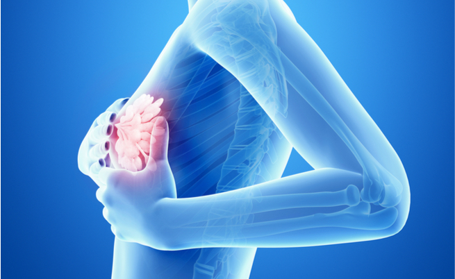 tumore al seno senza chemioterapia: le novità da ASCO 2018