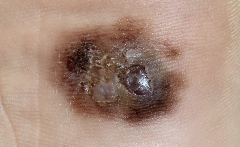 Melanoma: i Sintomi
