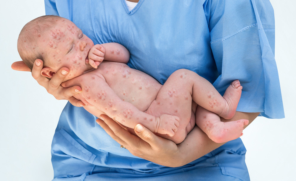 Vaccino: Cosa Accadrebbe se non ci vaccinasse più