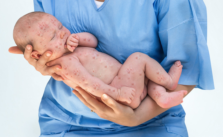 Vaccino: Cosa Accadrebbe se non ci vaccinasse più