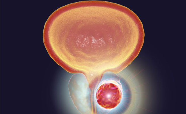 test iso psa per il tumore alla prostata: evita le biopsie