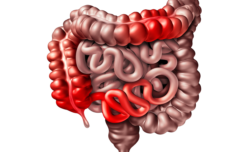 colite Colite e Morbo di Crohn: le Domande dei Pazienti.