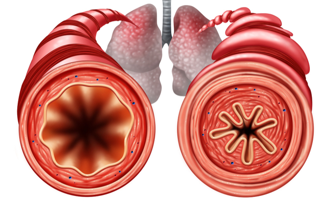 Perché viene l'asma di notte? Le cause e i rimedi
