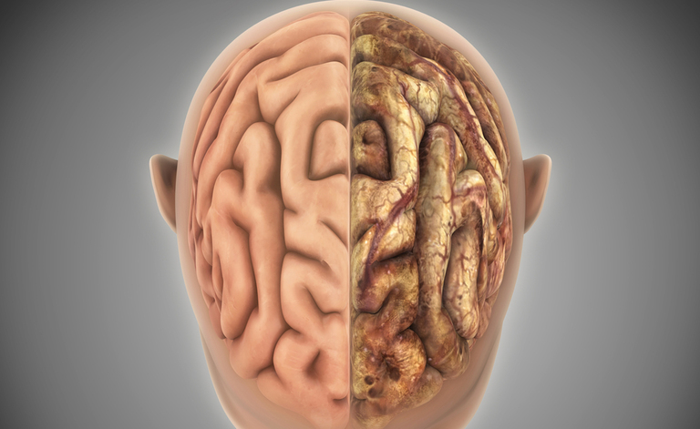 Ictus: i Sintomi per riconoscerlo e Prevenirlo