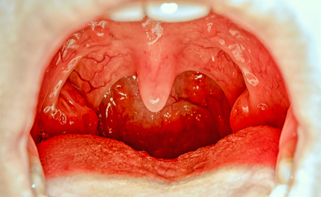 Palato gonfio e dolorante cosa fare