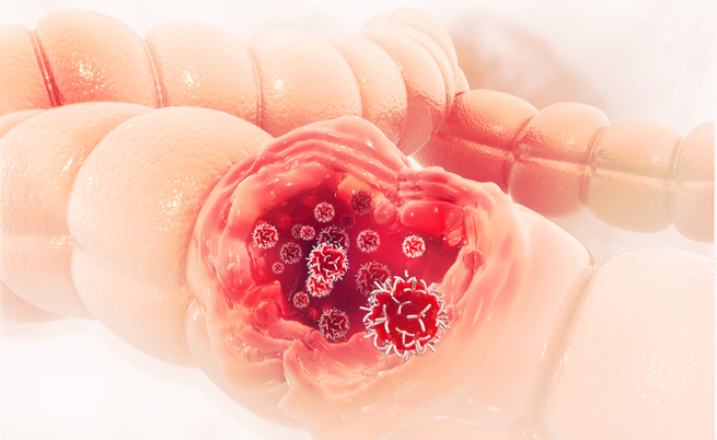 Tumore al colon: la dieta per prevenire il cancro e le recidive