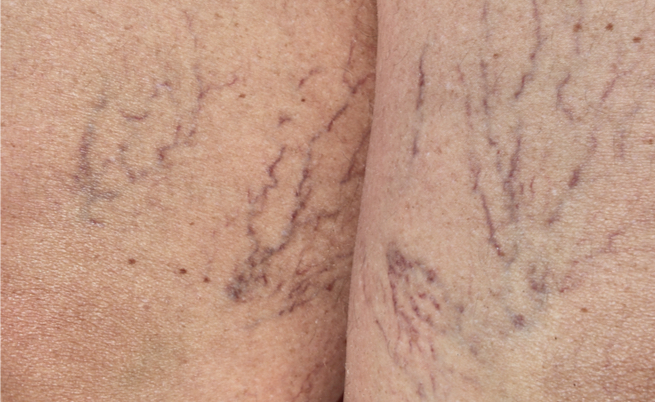 Come eliminare i capillari rotti