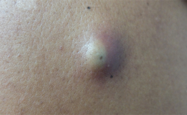 Cisti sebacea: sintomi, cause e rimedi